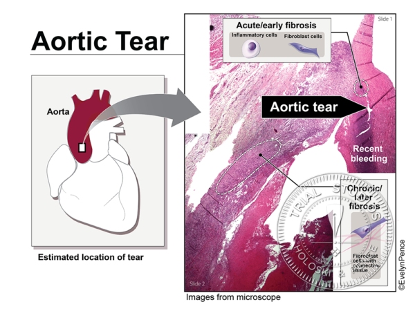 Enhanced histology micrographs showing an aortic dissection (tear) with an anatomical diagram of the heart to show the location of the tear.