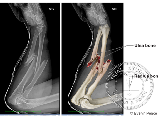 Interpreted x-ray of a a forearm fracture showing a broken radius and broken ulna