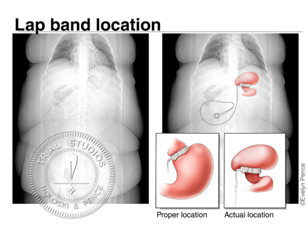 Abdominal X-ray or CT scan showing the location of a slipped lap band, with illustrations comparing the proper and actual positions of the band around the stomach, and illustration interpreting the scan to show position of the band and port to the stomach.