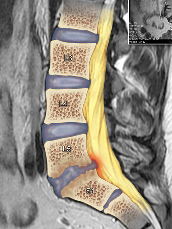 MRI