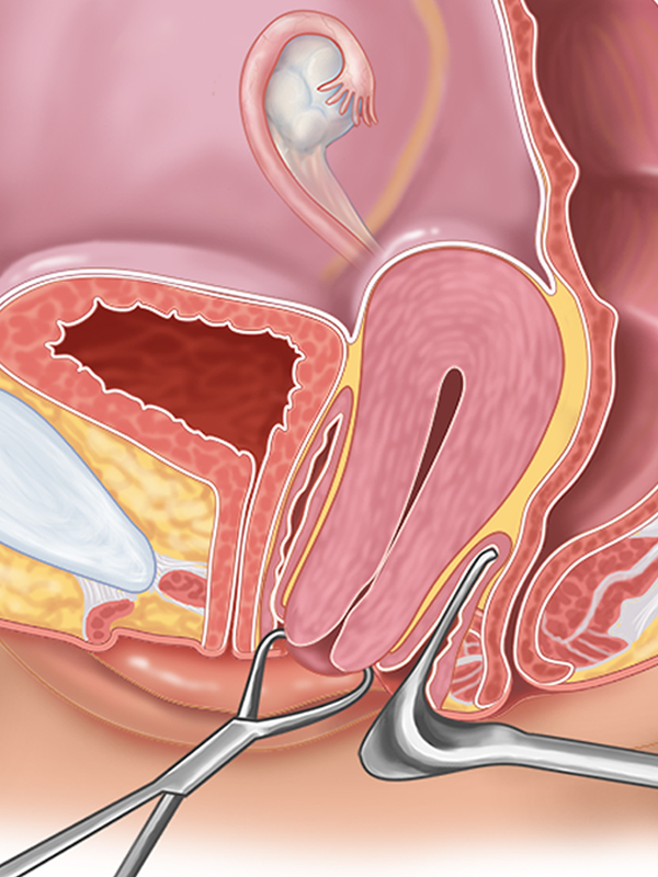 hysterectomy
