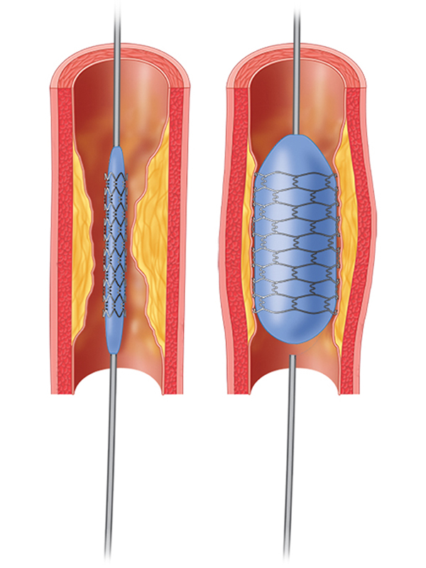 stent